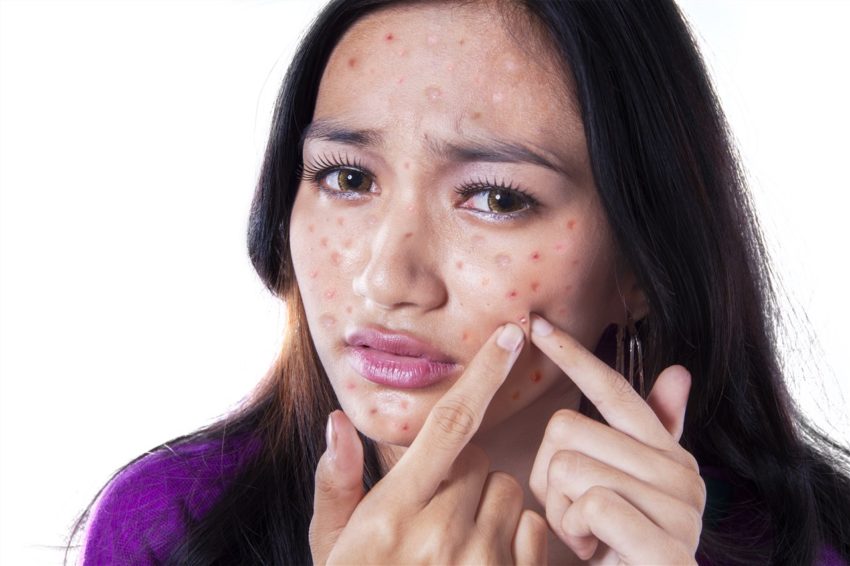 how to eliminate acne